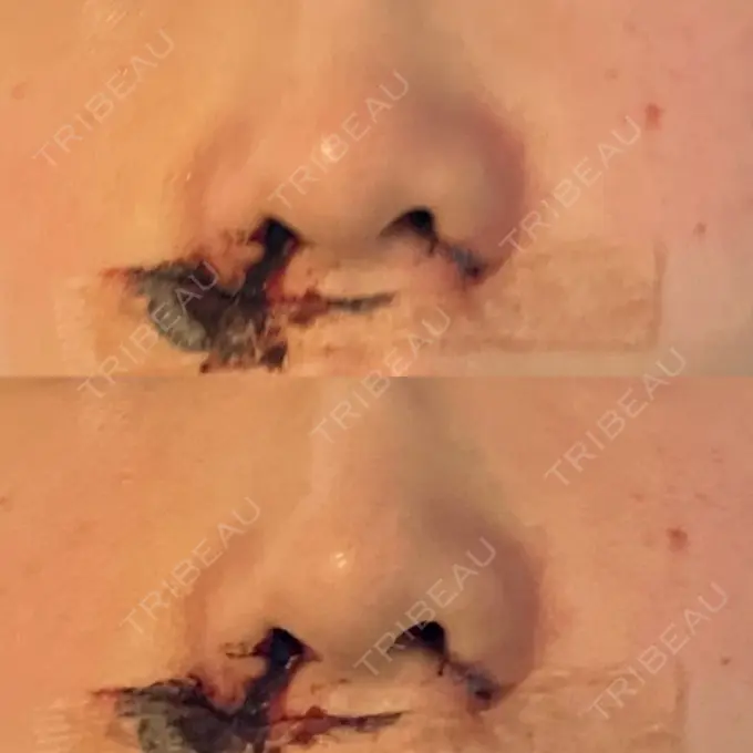 小鼻縮小（切開） 銀座S美容・形成外科クリニック DAY 1 メイン用