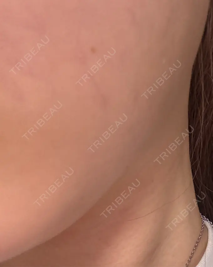 ボトックス（エラ・小顔） / ボトックス（ふくらはぎ） BiBiクリニック DAY 18 メイン用