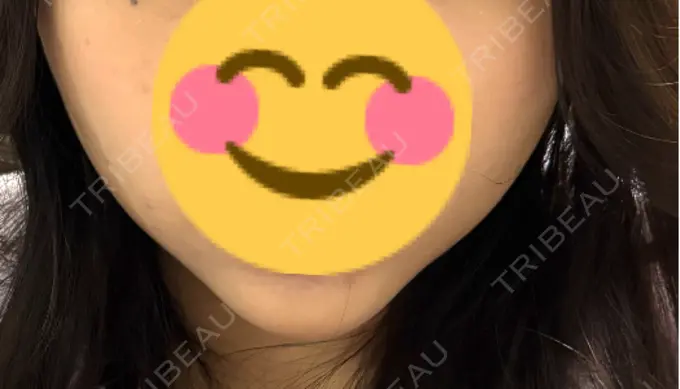 糸リフト / バッカルファット除去 / その他（輪郭） MEMOTO CLINIC 名古屋 DAY 7 メイン用