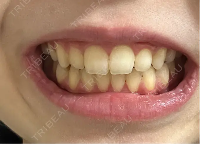 ホワイトニング LEAGRANT CLINIC 中目黒 DAY 56 メイン用