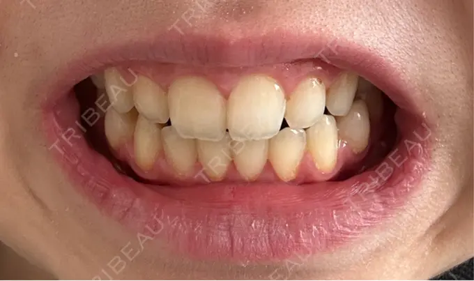 ホワイトニング LEAGRANT CLINIC 中目黒 AFTER メイン用