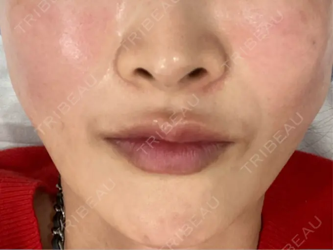 糸リフト / ヒアルロン酸注入（鼻翼基部） / リジュラン Brandnew Beauty Clinic DAY 0 メイン用