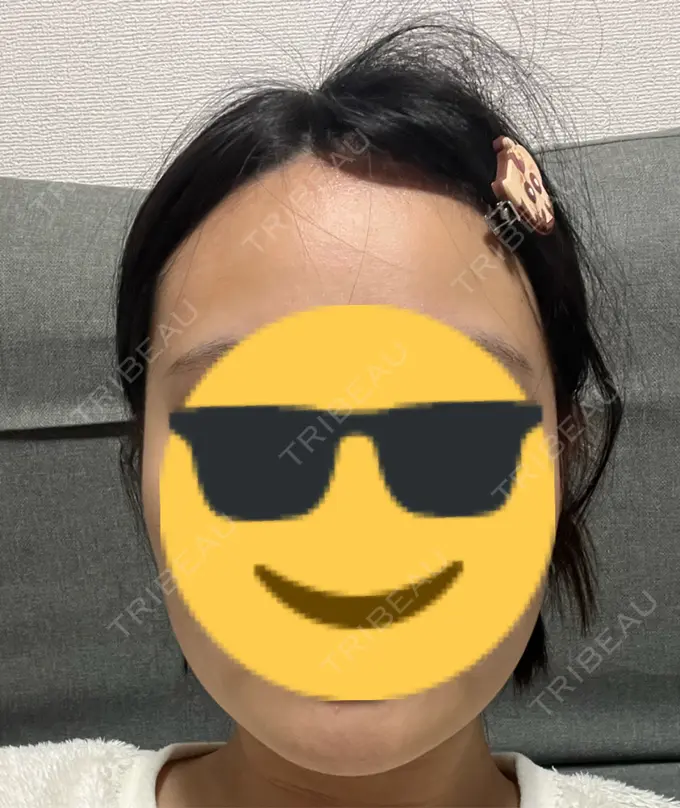 ボトックス（エラ・小顔） ルラ美容クリニック 大阪心斎橋院 DAY 19 メイン用