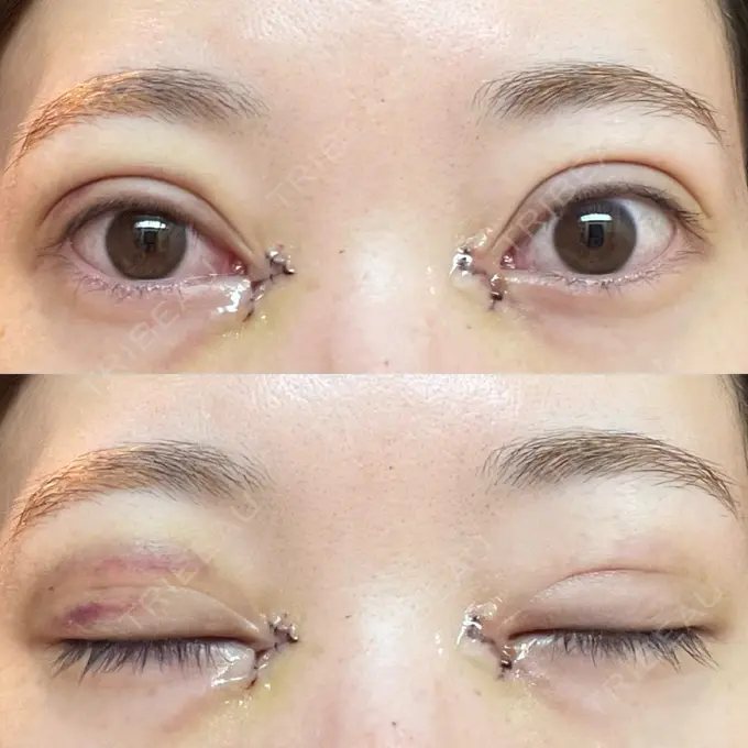 二重埋没 / 目頭切開 アリエル美容クリニック 郡山院 DAY 2 メイン用