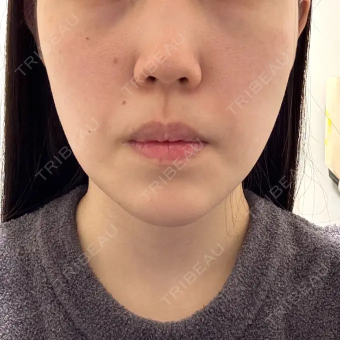 糸リフト / ヒアルロン酸注入（あご） L‘amour clinic Tokyo【ラムールクリニック東京】 DAY 14 メイン用