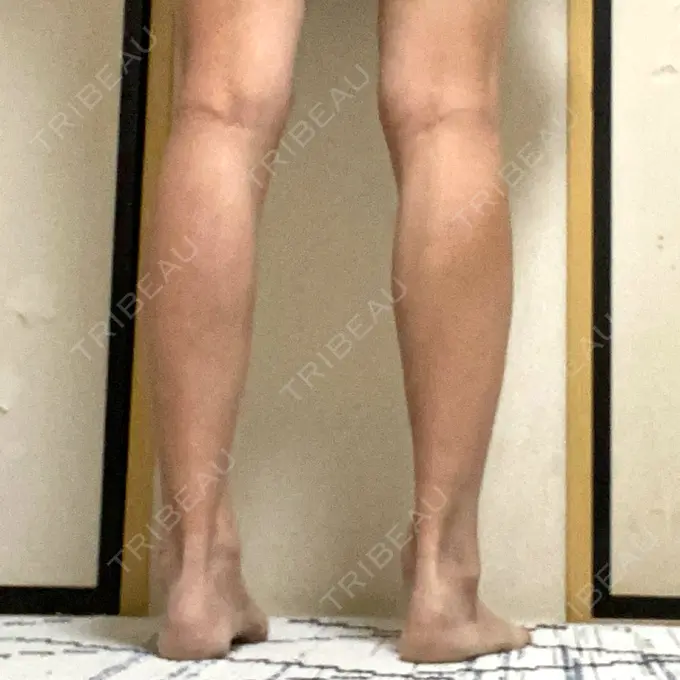 ボトックス（ふくらはぎ） TCB東京中央美容外科 神戸院 DAY 17 メイン用