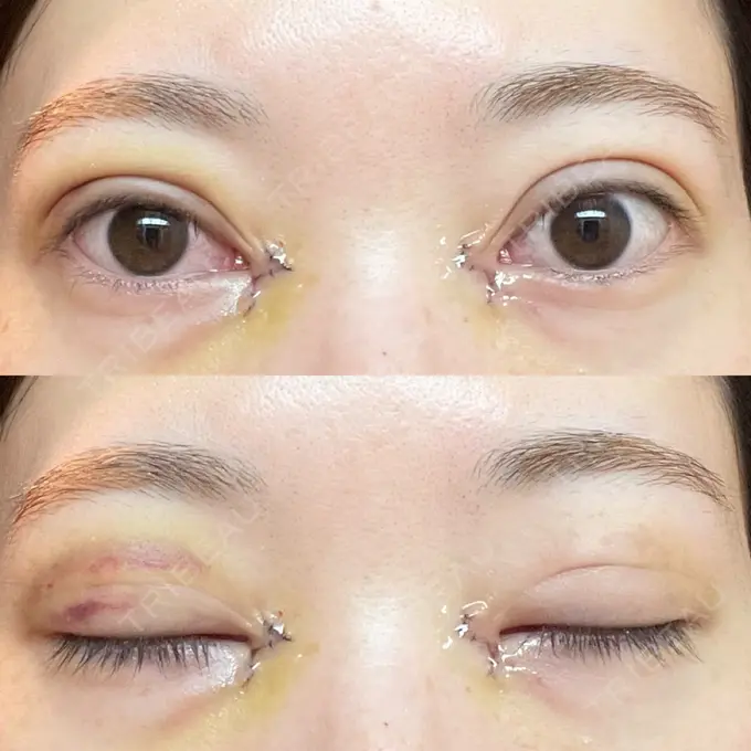 二重埋没 / 目頭切開 アリエル美容クリニック 郡山院 DAY 3 メイン用