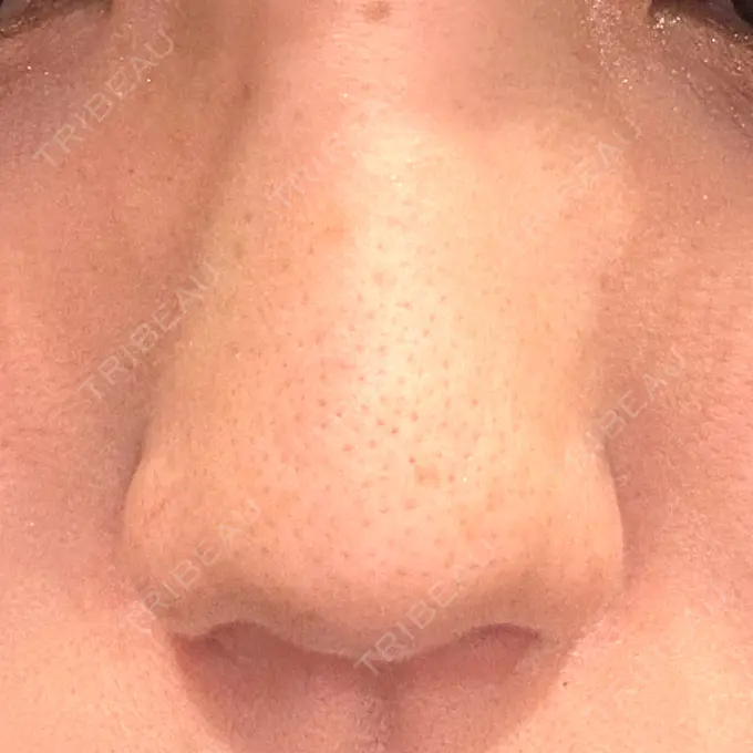 小鼻縮小（切開） / 鼻翼挙上 / その他（鼻） 東京形成美容外科 銀座院 DAY 32 メイン用