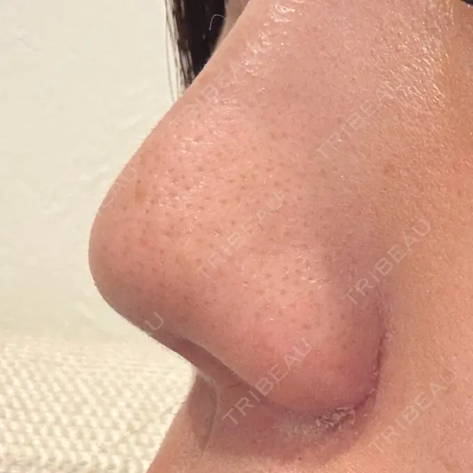 小鼻縮小（切開） / 鼻翼挙上 / その他（鼻） 東京形成美容外科 銀座院 DAY 32 メイン用