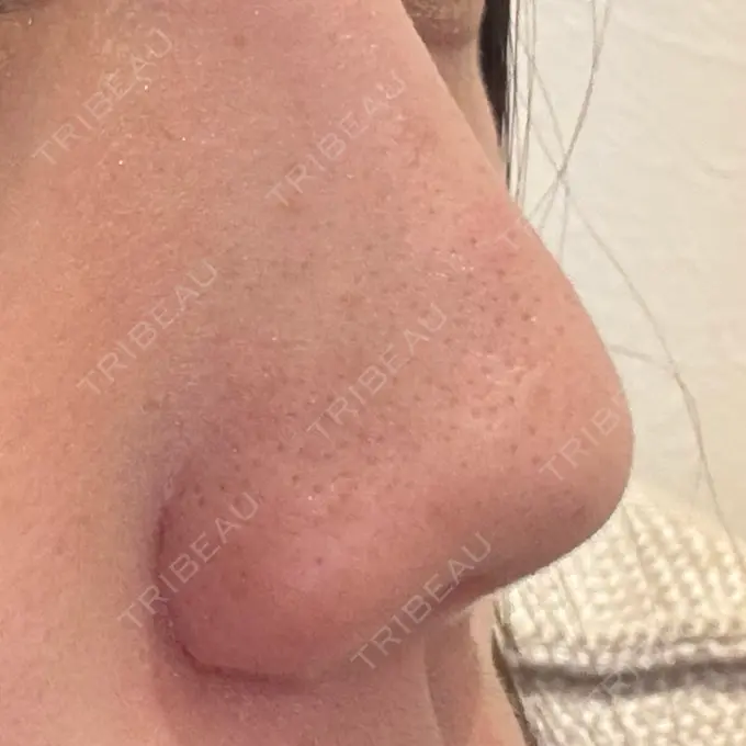 小鼻縮小（切開） / 鼻翼挙上 / その他（鼻） 東京形成美容外科 銀座院 DAY 32 メイン用