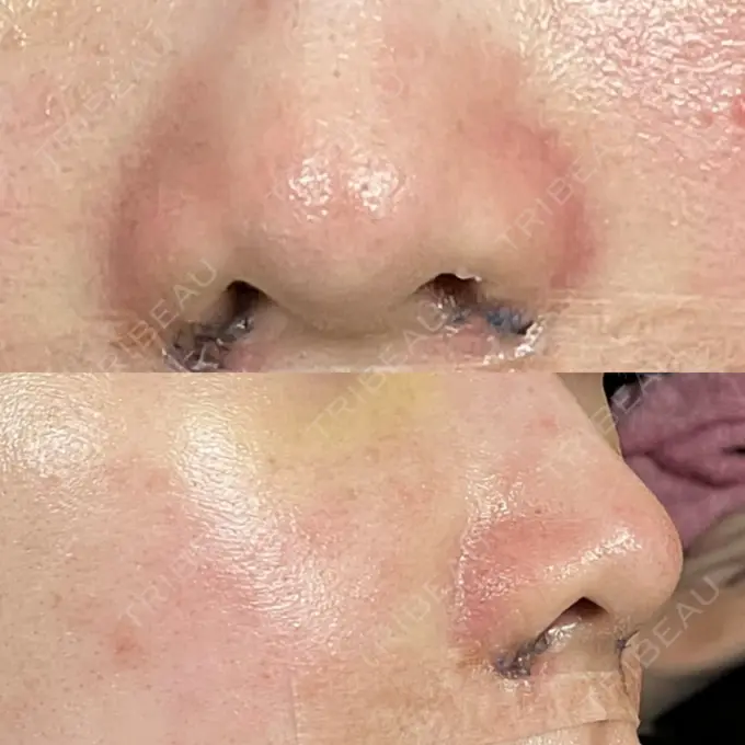 小鼻縮小（切開） 銀座S美容・形成外科クリニック DAY 3 メイン用