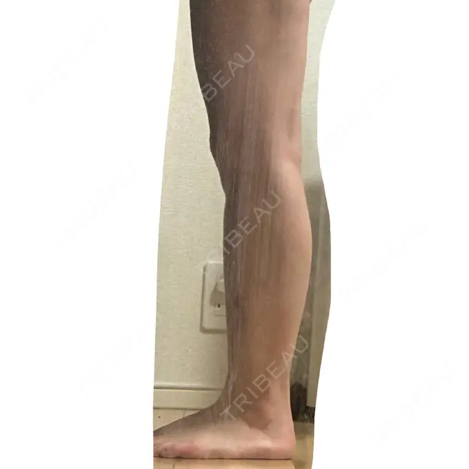 脂肪吸引（脚） / 脂肪吸引（お尻） Mods Clinic（モッズクリニック） 名古屋院 DAY 87 メイン用