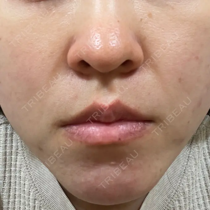 毛穴洗浄（ハイドラフェイシャルなど） 東京素肌クリニック 銀座本院 DAY 6 メイン用