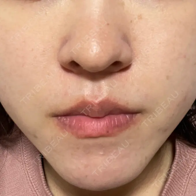 毛穴洗浄（ハイドラフェイシャルなど） 東京素肌クリニック 銀座本院 DAY 7 メイン用