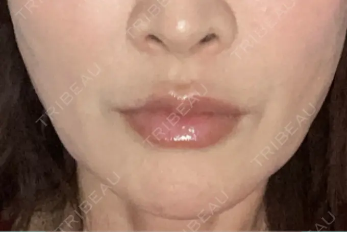 糸リフト / ヒアルロン酸注入（鼻翼基部） / リジュラン Brandnew Beauty Clinic DAY 2 メイン用