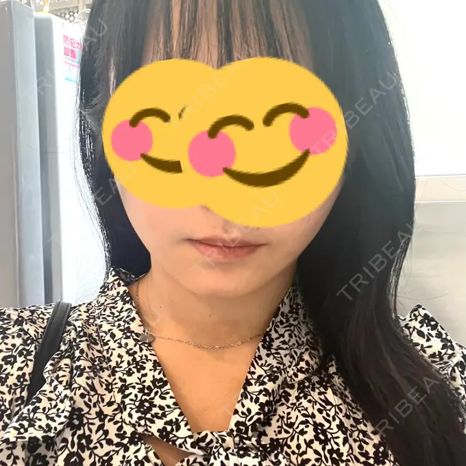 脂肪吸引（顔） / 脂肪吸引（二の腕） 湘南美容クリニック Regno 銀座院 AFTER メイン用