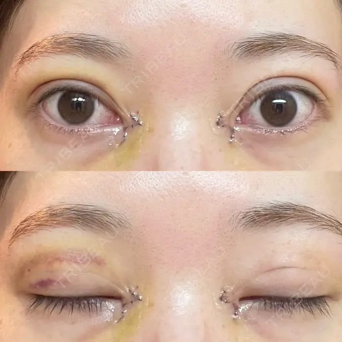 二重埋没 / 目頭切開 アリエル美容クリニック 郡山院 DAY 4 メイン用