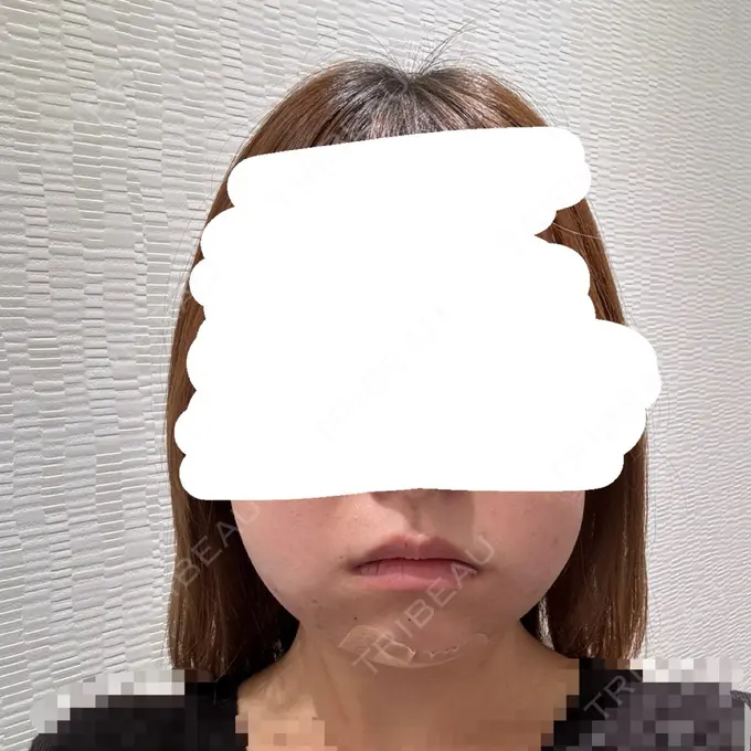 脂肪吸引（顔） Mods Clinic（モッズクリニック） 名古屋院 DAY 0 メイン用