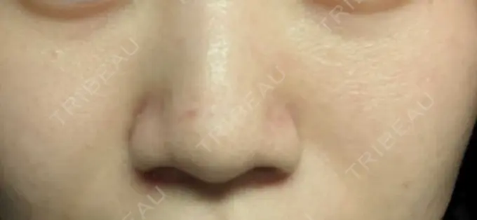 ピーリング（ニキビ・毛穴） / イオン導入 / 光治療（フォトフェイシャルなど） 東京素肌クリニック 銀座本院 DAY 0 メイン用