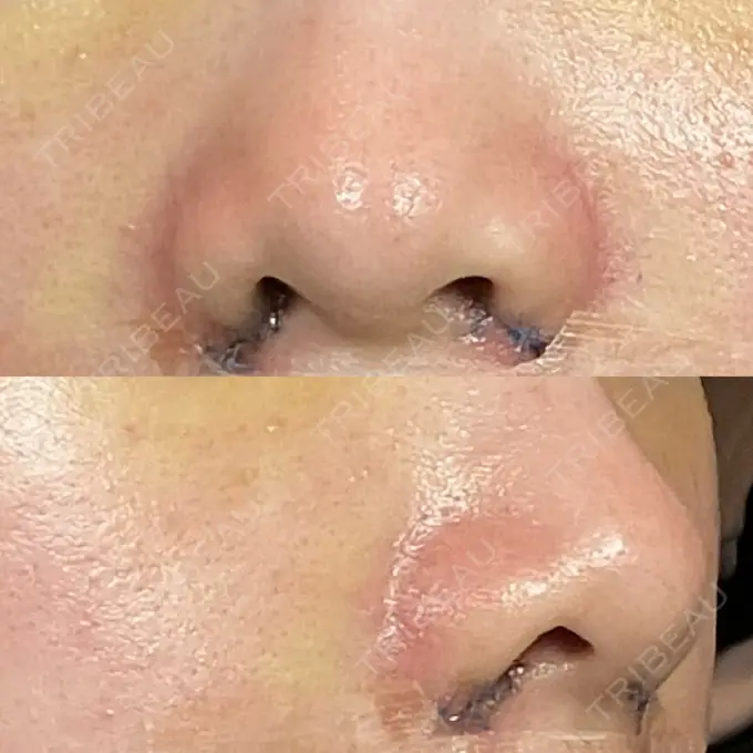 小鼻縮小（切開） 銀座S美容・形成外科クリニック DAY 4 メイン用