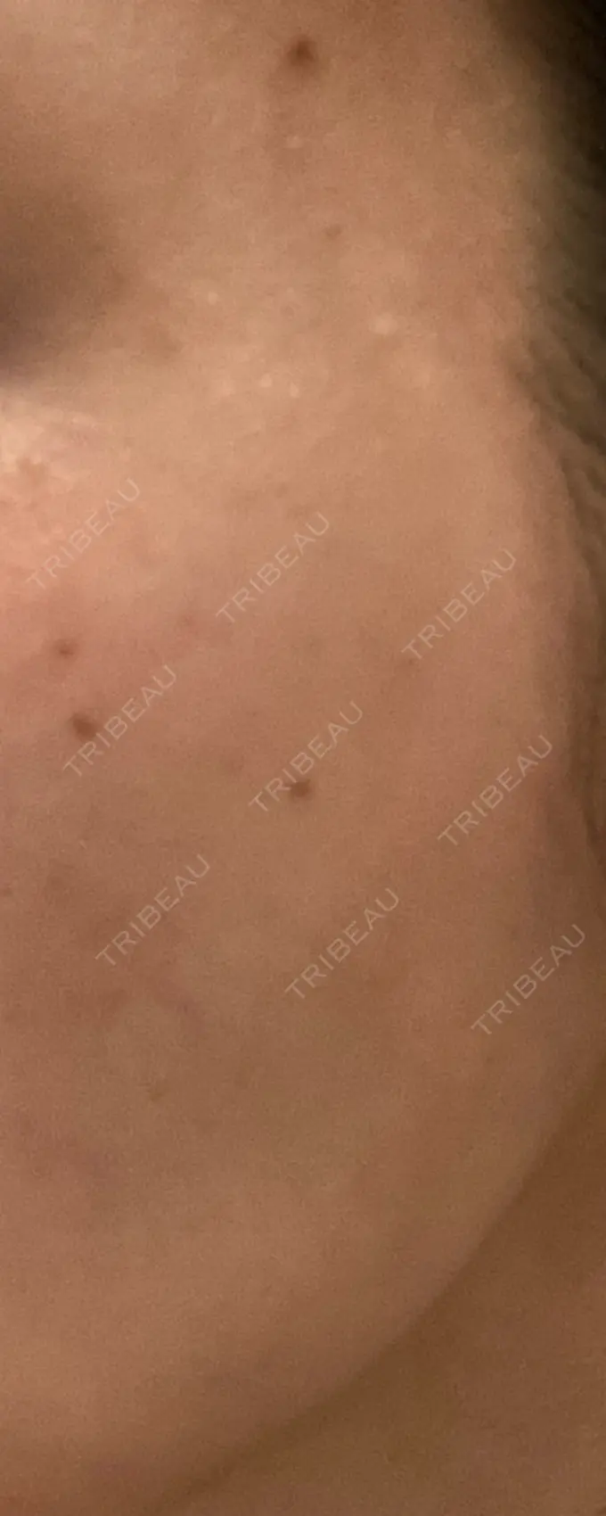 ピーリング（ニキビ・毛穴） / ルメッカ ルラ美容クリニック 静岡院 AFTER メイン用