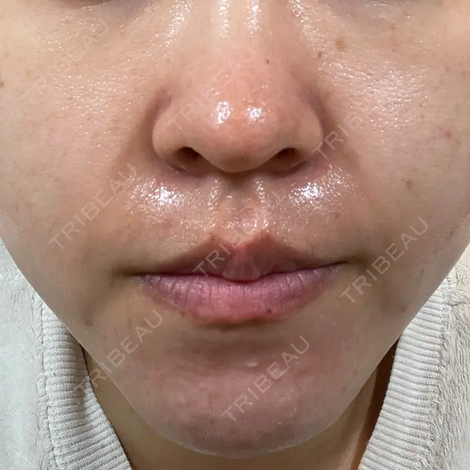 毛穴洗浄（ハイドラフェイシャルなど） 東京素肌クリニック 銀座本院 DAY 8 メイン用