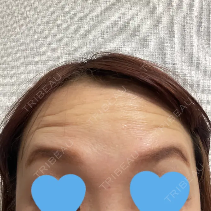 ボトックス（眉間） / ボトックス（額） TCB東京中央美容外科 北千住院 DAY 1 メイン用