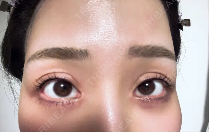 アートメイク（アイライン） 筋肉・美容クリニック DAY 1 メイン用