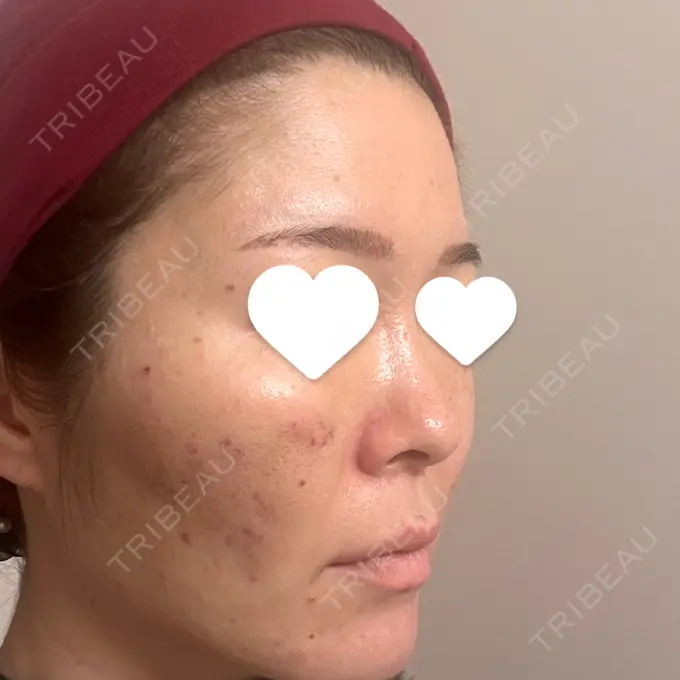 サブシジョン 藤・ナチュレ美容クリニック 銀座院 DAY 2 メイン用