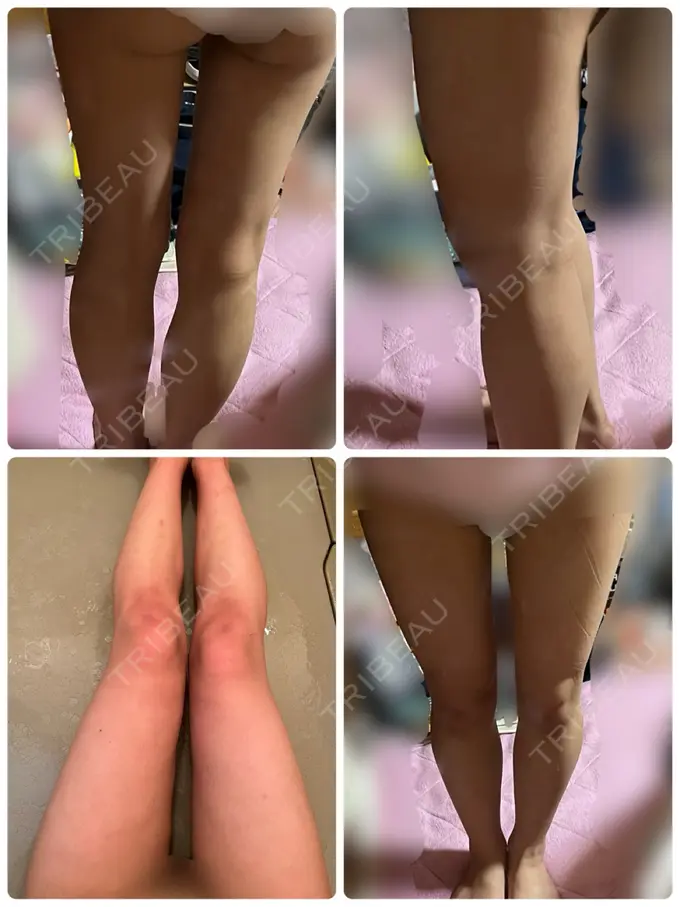 脂肪吸引（顔） / 脂肪吸引（脚） Mods Clinic（モッズクリニック） 名古屋院 DAY 30 メイン用