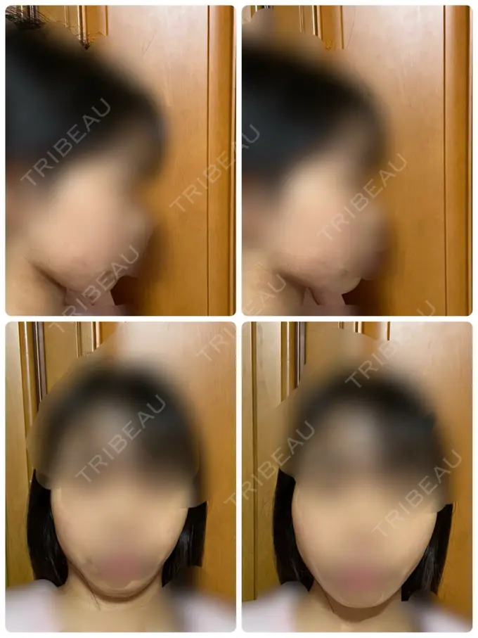 脂肪吸引（顔） / 脂肪吸引（脚） Mods Clinic（モッズクリニック） 名古屋院 DAY 30 メイン用