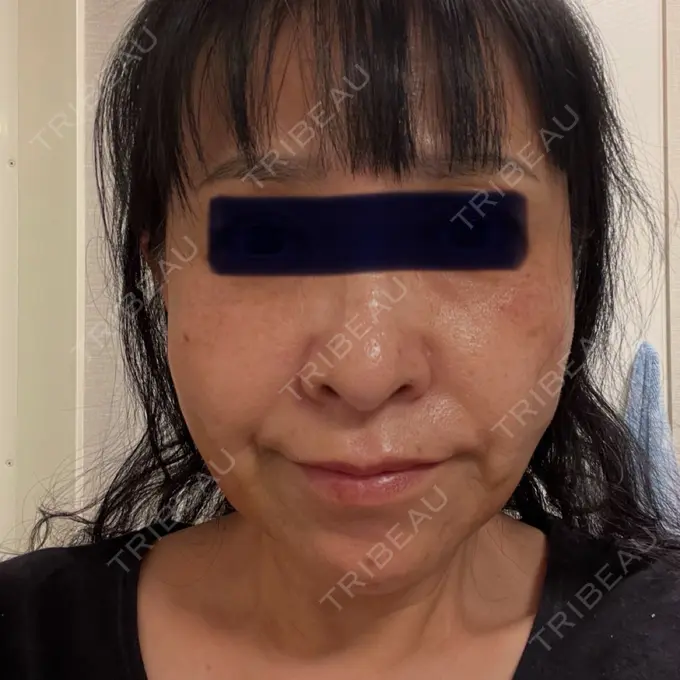 糸リフト / ボトックス（あご） / ヒアルロン酸注入（あご） / ヒアルロン酸注入（唇） / シワ取りボトックス / ヒアルロン酸注入（鼻翼基部） / その他（目元） ルラ美容クリニック 仙台院 / ルラスキンクリニック 仙台院 AFTER メイン用