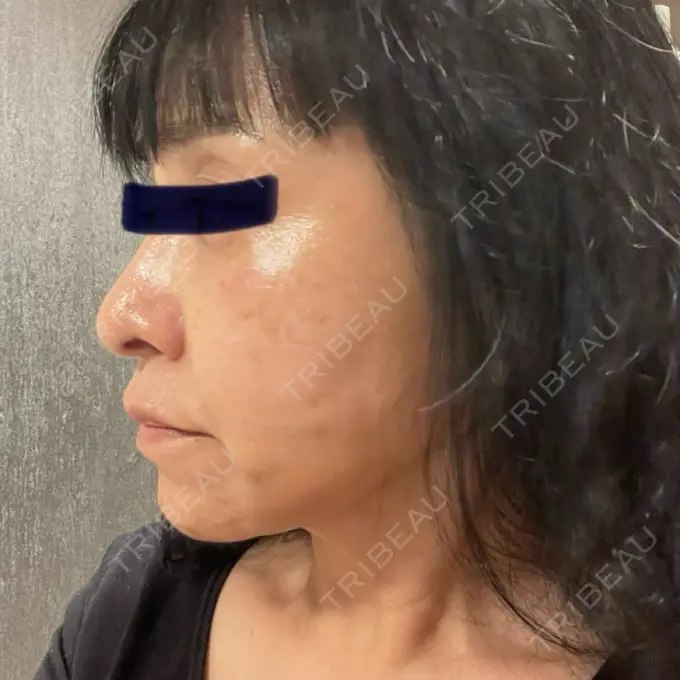 糸リフト / ボトックス（あご） / ヒアルロン酸注入（あご） / ヒアルロン酸注入（唇） / シワ取りボトックス / ヒアルロン酸注入（鼻翼基部） / その他（目元） ルラ美容クリニック 仙台院 / ルラスキンクリニック 仙台院 DAY 2 メイン用