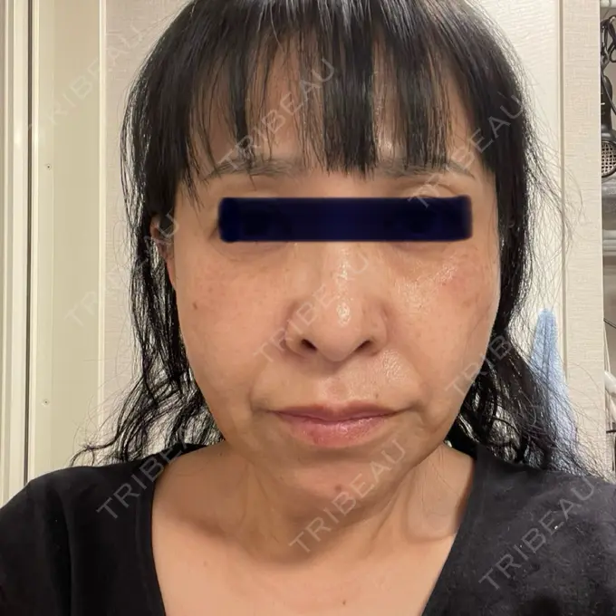 糸リフト / ボトックス（あご） / ヒアルロン酸注入（あご） / ヒアルロン酸注入（唇） / シワ取りボトックス / ヒアルロン酸注入（鼻翼基部） / その他（目元） ルラ美容クリニック 仙台院 / ルラスキンクリニック 仙台院 DAY 2 メイン用