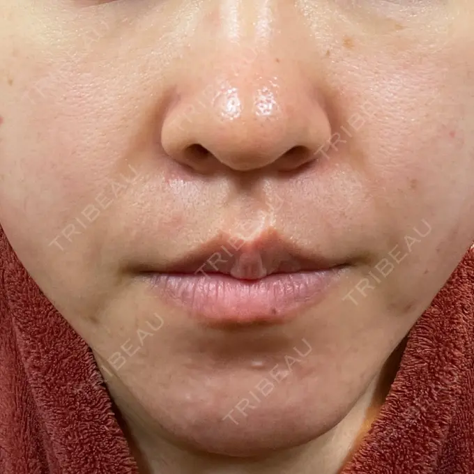 毛穴洗浄（ハイドラフェイシャルなど） 東京素肌クリニック 銀座本院 DAY 9 メイン用