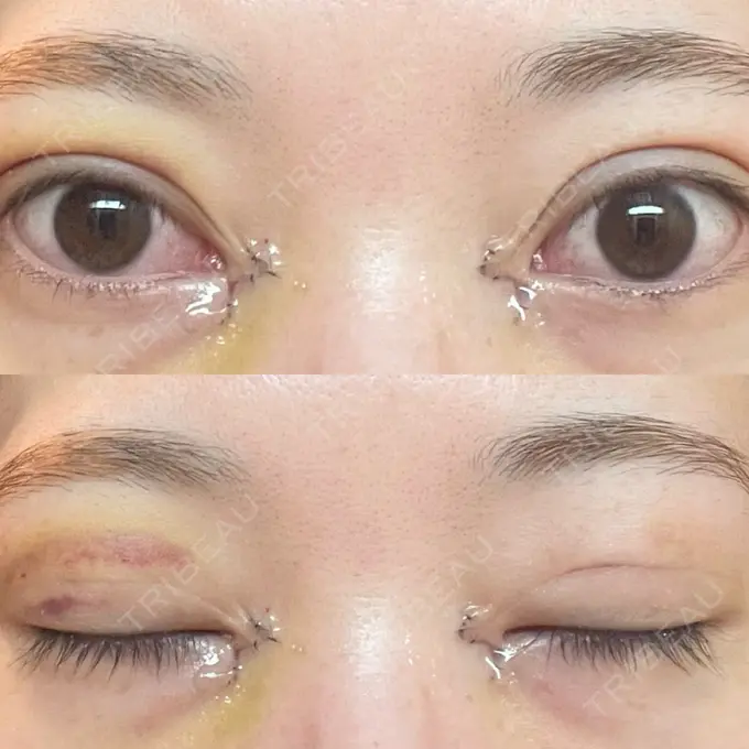 二重埋没 / 目頭切開 アリエル美容クリニック 郡山院 DAY 5 メイン用