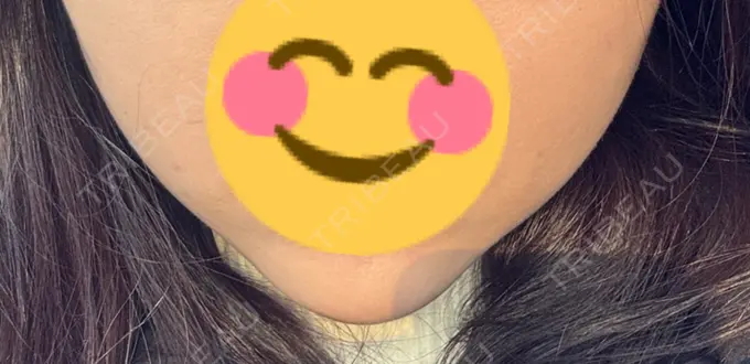 糸リフト / バッカルファット除去 / その他（輪郭） MEMOTO CLINIC 名古屋 DAY 9 メイン用