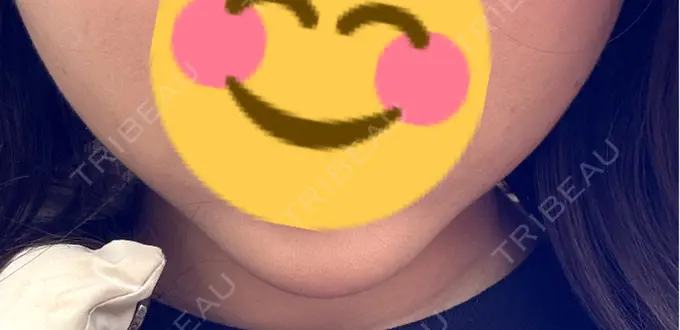 糸リフト / バッカルファット除去 / その他（輪郭） MEMOTO CLINIC 名古屋 DAY 10 メイン用