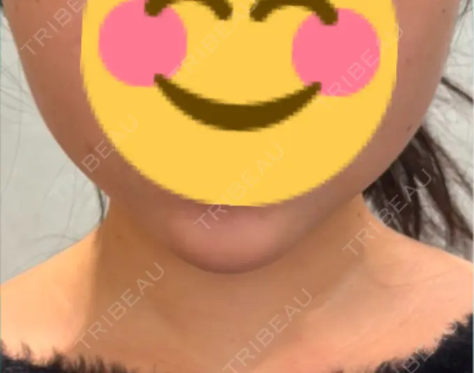 糸リフト / バッカルファット除去 / その他（輪郭） MEMOTO CLINIC 名古屋 DAY 8 メイン用