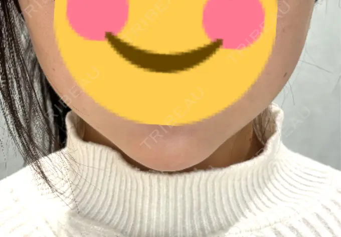 糸リフト / バッカルファット除去 / その他（輪郭） MEMOTO CLINIC 名古屋 DAY 11 メイン用