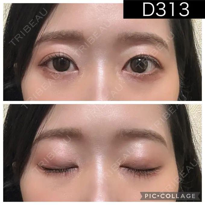 二重埋没 湘南美容クリニック 町田院 DAY 313 メイン用