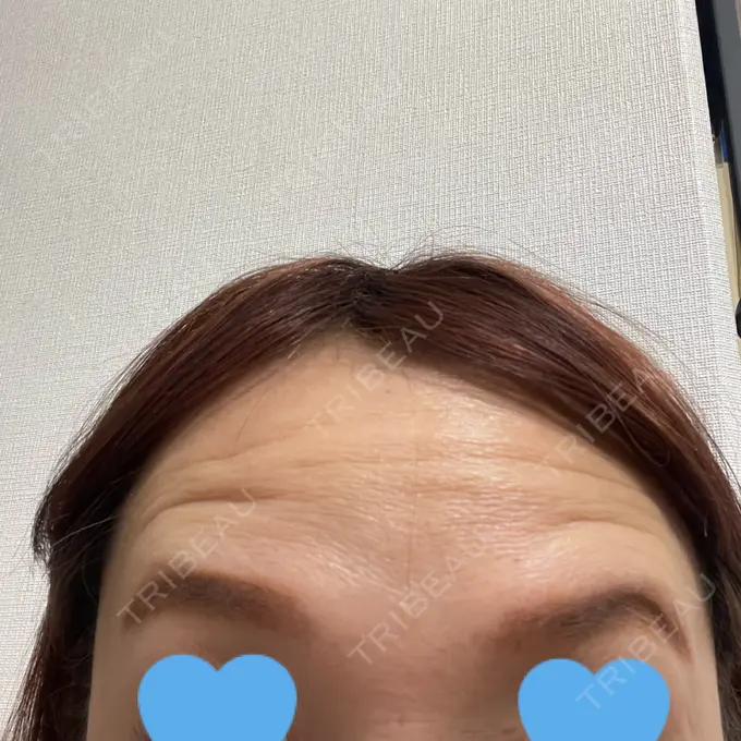 ボトックス（眉間） / ボトックス（額） TCB東京中央美容外科 北千住院 DAY 2 メイン用