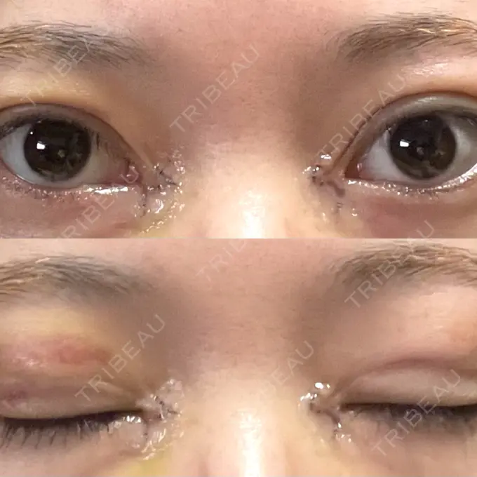 二重埋没 / 目頭切開 アリエル美容クリニック 郡山院 DAY 6 メイン用