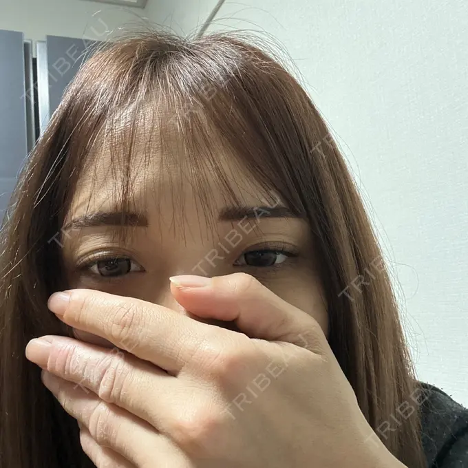 アートメイク（唇） しんゆり美容健康クリニック AFTER メイン用