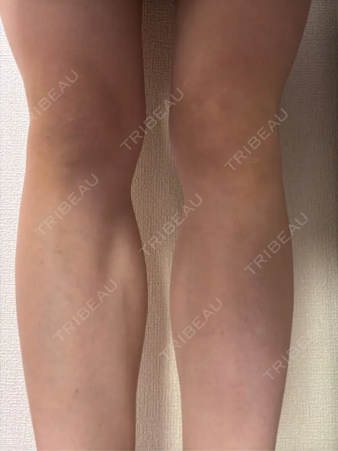 ボトックス（エラ・小顔） / ボトックス（ふくらはぎ） BiBiクリニック AFTER メイン用