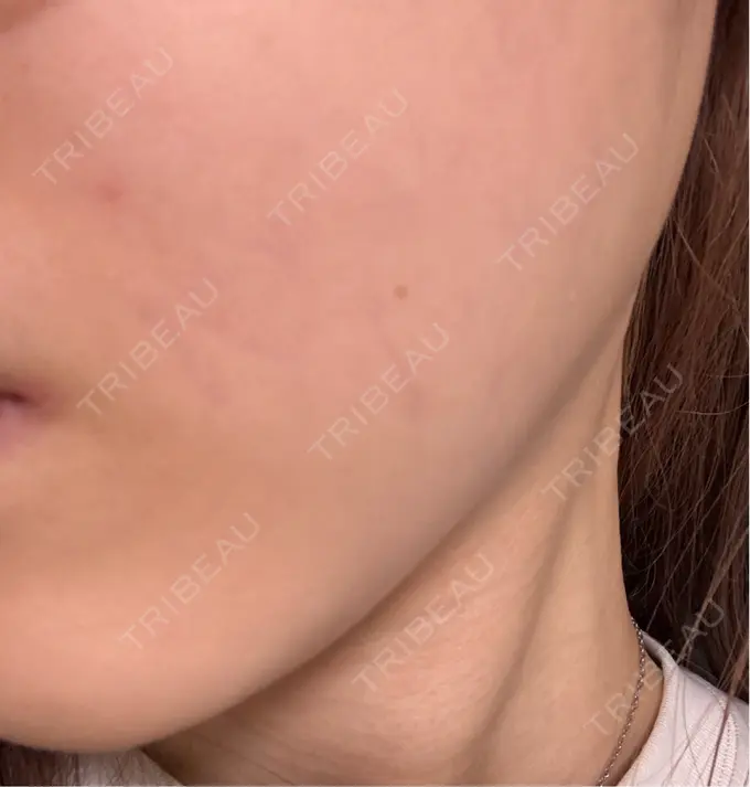 ボトックス（エラ・小顔） / ボトックス（ふくらはぎ） BiBiクリニック DAY 20 メイン用