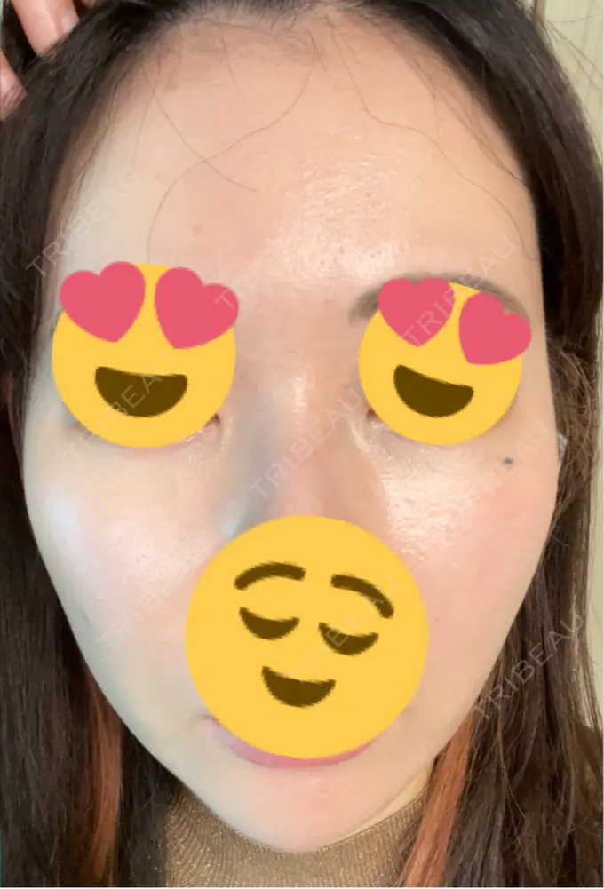 ピーリング（ニキビ・毛穴） / ヴェルヴェットスキン / ピーリング（ハリ・ツヤ） ミニマムスキンクリニック池袋 DAY 2 メイン用