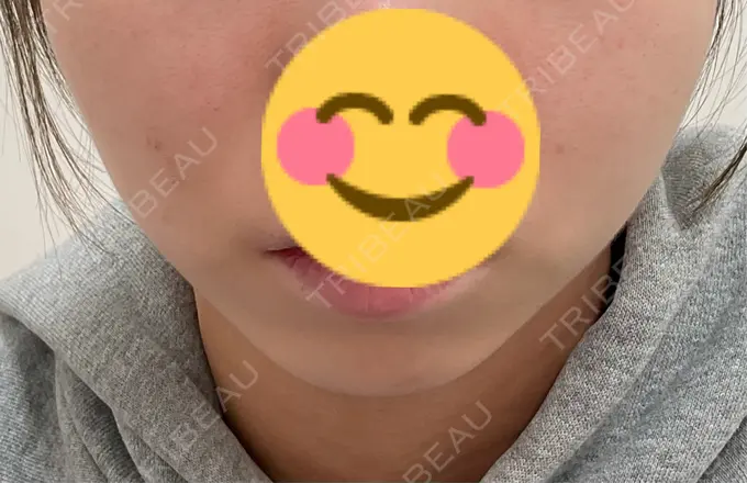 ボトックス（エラ・小顔） / 脂肪溶解注射（顔） 仙台N美容クリニック DAY 0 メイン用