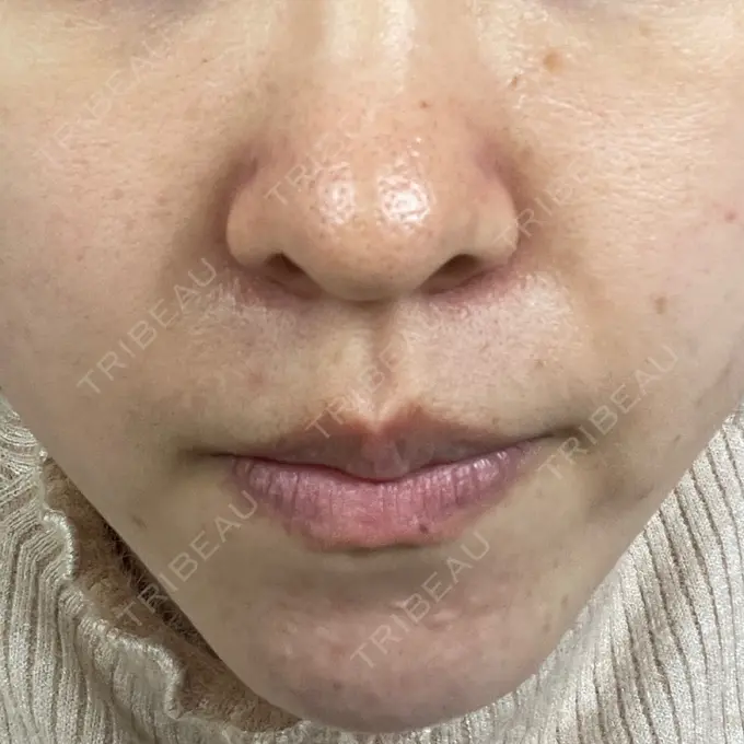 毛穴洗浄（ハイドラフェイシャルなど） 東京素肌クリニック 銀座本院 DAY 10 メイン用