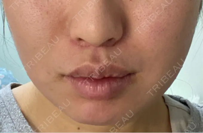 人中短縮 / 口唇縮小術 / 口角挙上 新宿ラクル美容外科クリニック 新宿院 AFTER メイン用